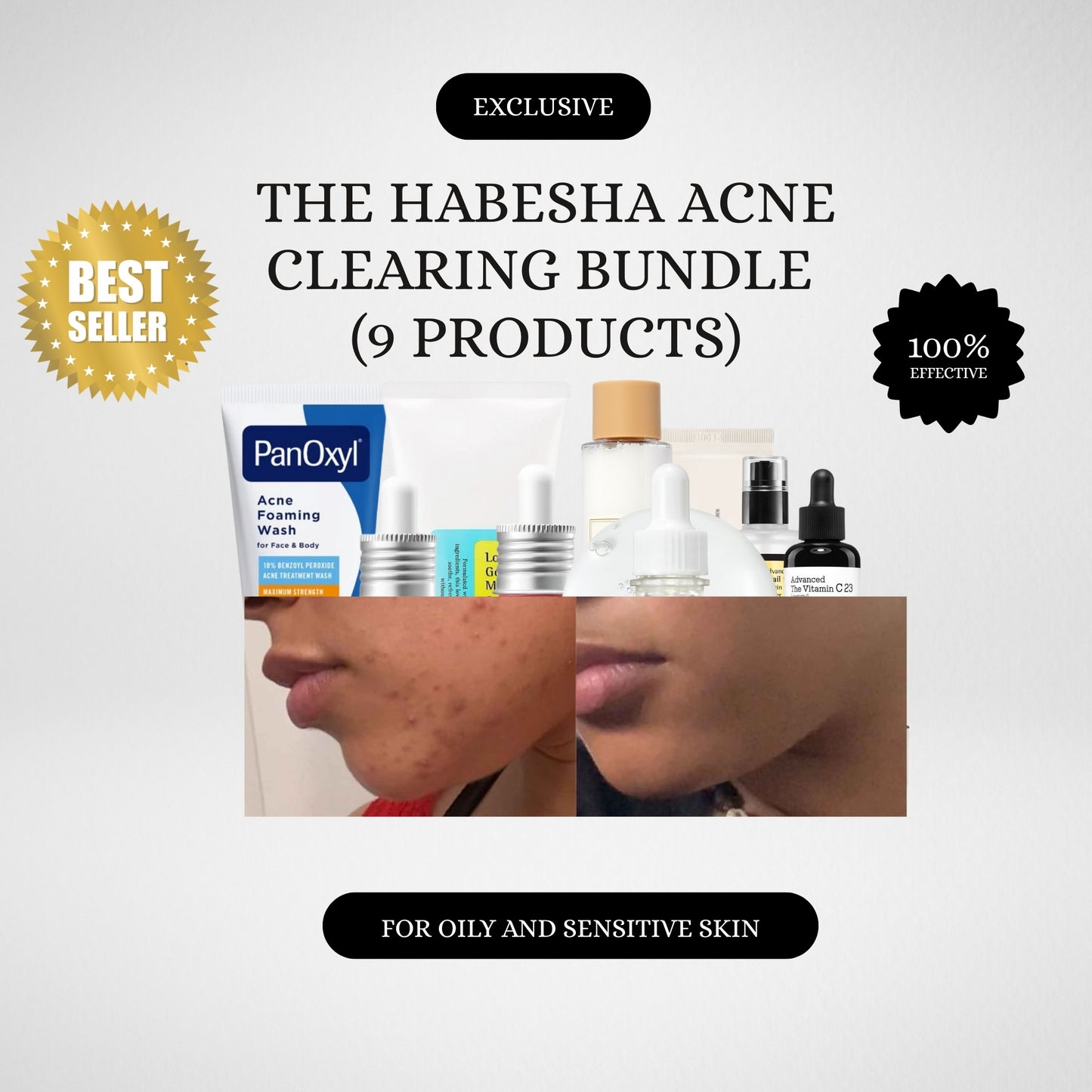 The Habesha Acne Clarifying Bundle   ናይ ፈጸጋ መጽረዪ ኮምቦ ( 8 ፖሮዳክትስ ዘጠቃለለ)